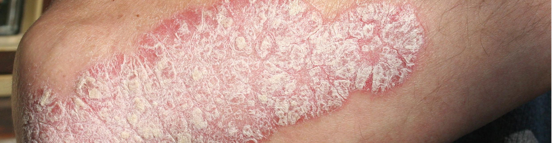 psoriasis en bier