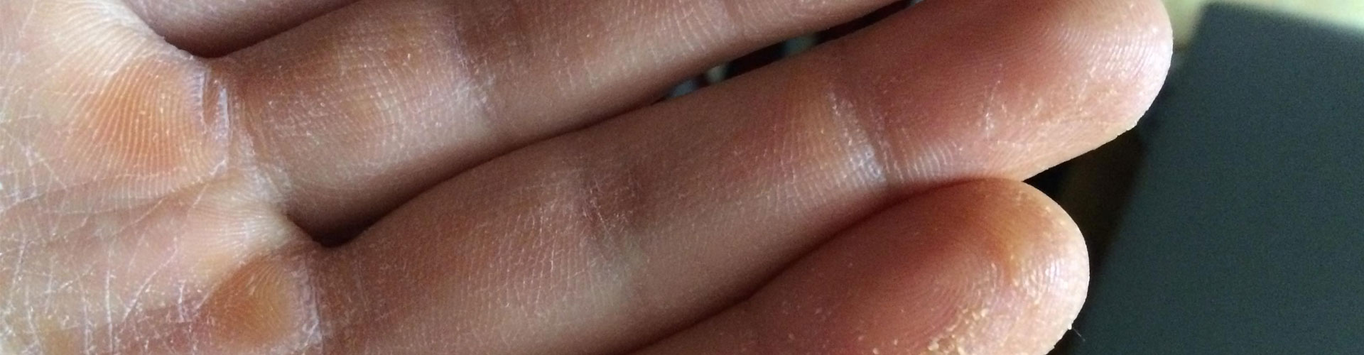 Atopik Dermatit Bitkisel Tedavi-Atopik Egzama İçin Bitkisel Çözümler Atopik Dermatit Bitkisel Tedavi-Atopik Egzama İçin Bitkisel Çözümler
