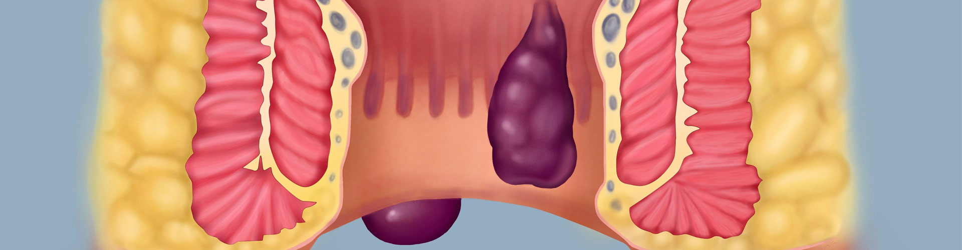 İç hemoroid belirtileri, nedenleri ve tedavisi İç hemoroid belirtileri, nedenleri ve tedavisi