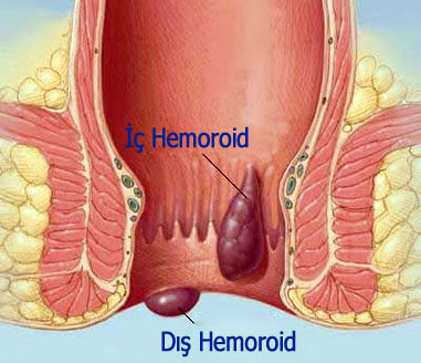 Hemoroid, Hemoroid Belirtileri ve Tedavisi