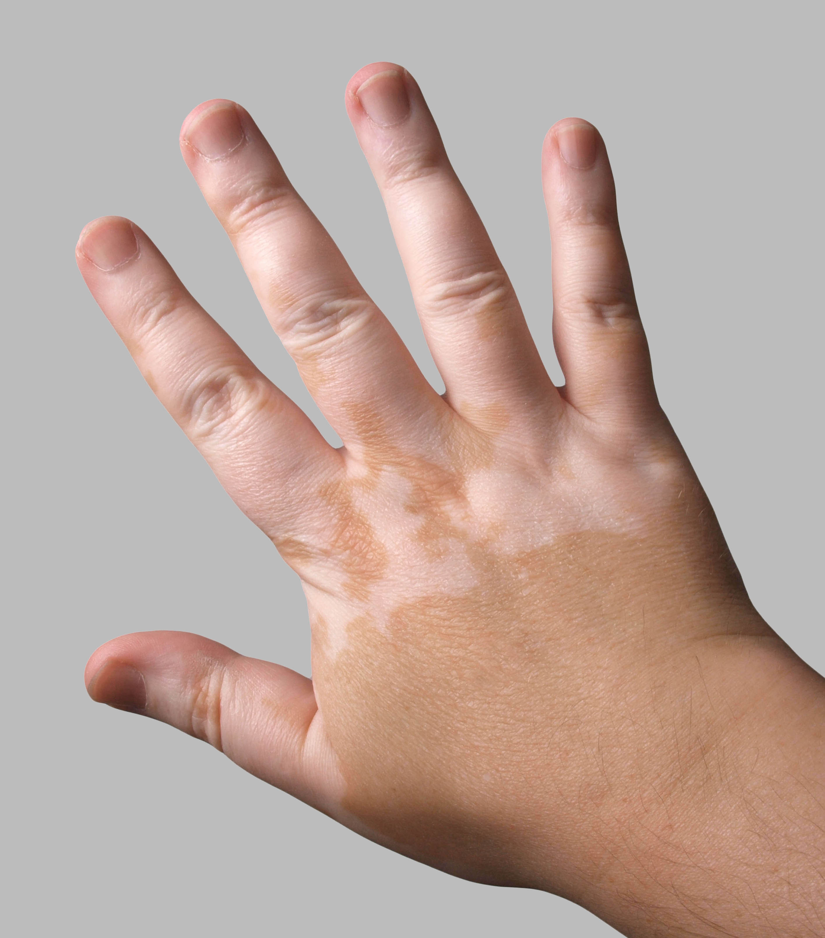 Vitiligo Hastalığı, Vitiligo Hastalığı Belirtileri ve Tedavisi