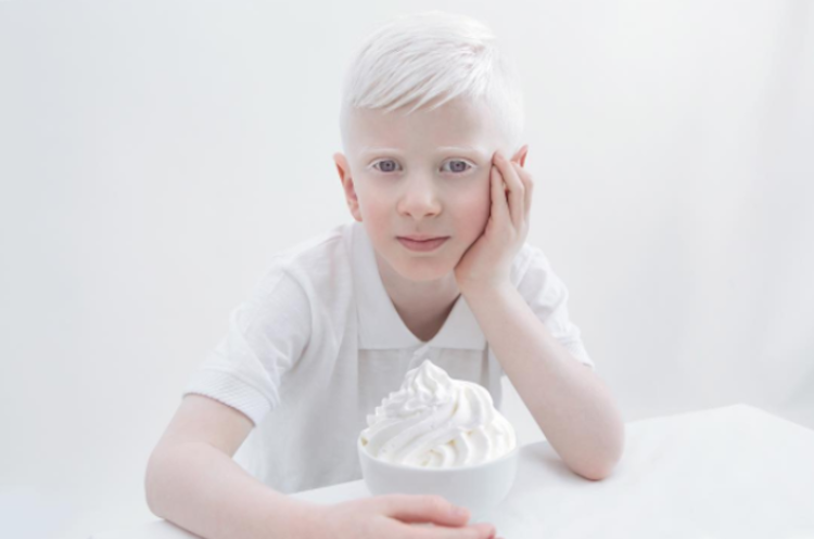 Albino Hastalığı, Albino Hastalığı Belirtileri ve Tedavisi
