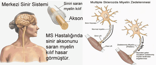 Multipl Skleroz(MS) ve Multipl Skleroz Belirtileri ve Tedavisi