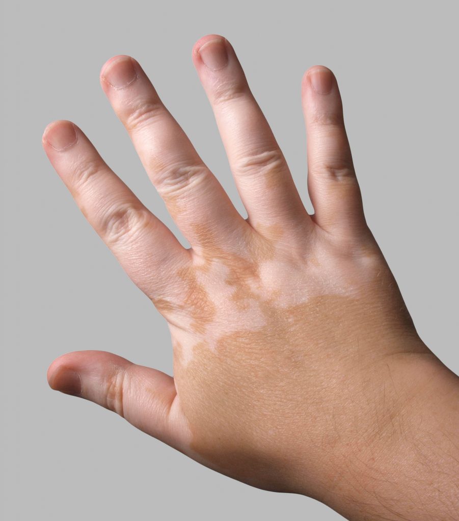 vitiligo-hastal-vitiligo-hastal-belirtileri-ve-tedavisi-do-al-t-p