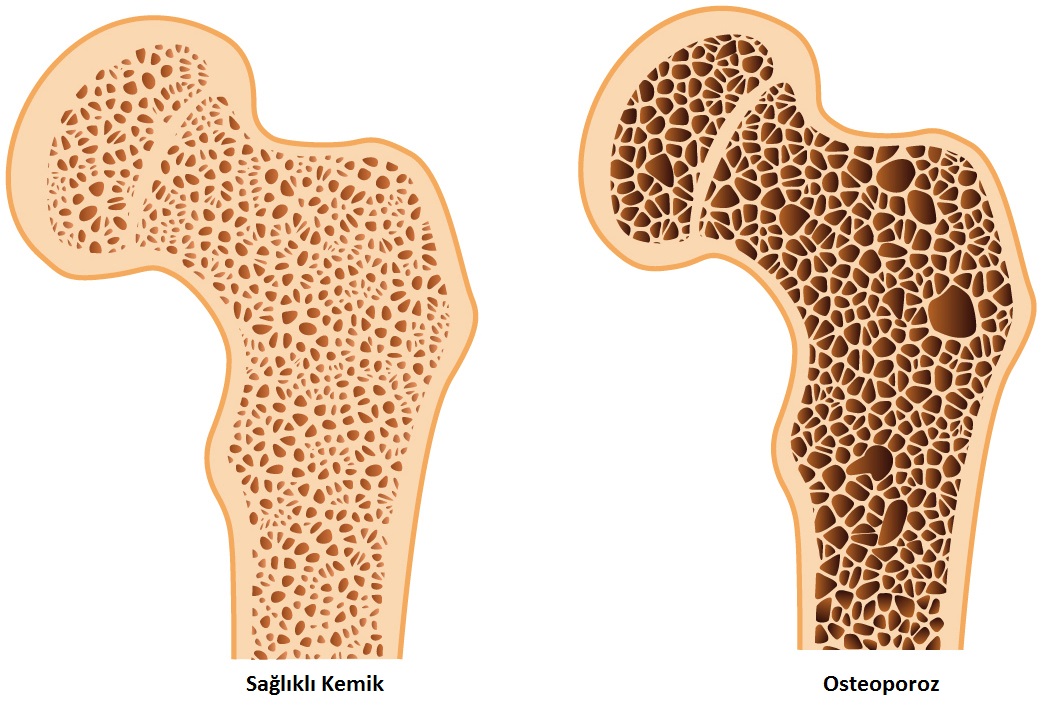 Osteoporoz Hastalığı, Osteoporoz Hastalığı Belirtileri ve Tedavisi