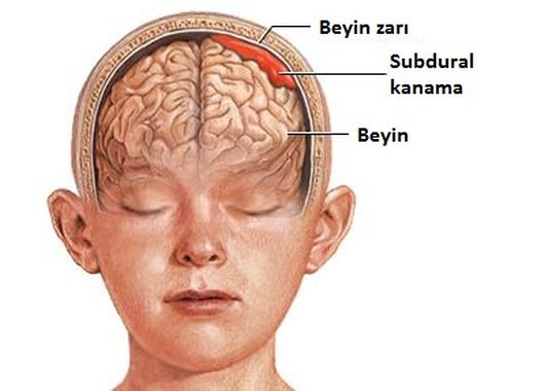 Beyin Kanaması, Beyin Kanaması Belirtileri ve Tedavisi